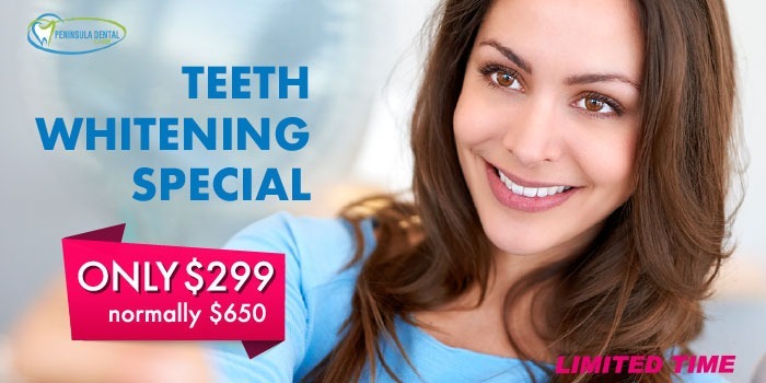 valentines day 15 off teeth whitening special